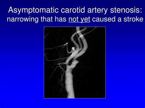PPT - Treatment for asymptomatic carotid artery stenosis: surgery or ...