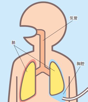 胸腔ドレーンの目的と挿入部位・排出メカニズム | ナース専科