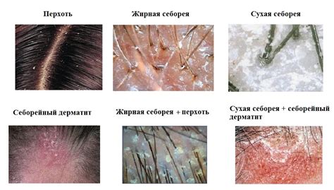 Себорея кожи головы - простое лечение в домашних условиях