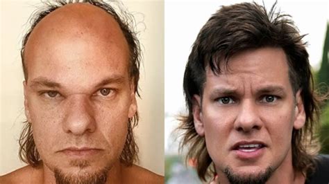 theo von hair transplant procedure results insights