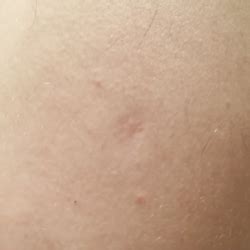 filebcg vaccine scarpng wikimedia commons