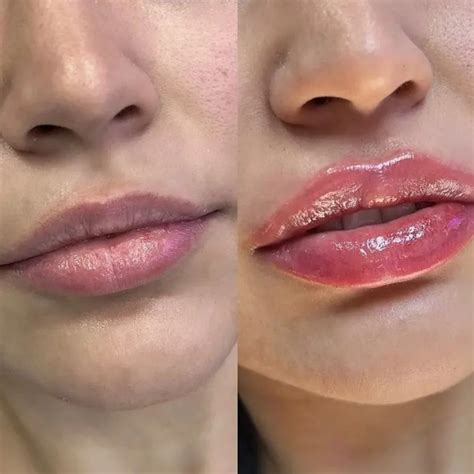 Lip Pill Set sjajeva za povećanje usana – Lip Pill Srbija