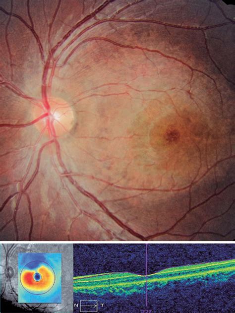 SciELO Brasil - Ophthalmological findings in ectodermal dysplasia ...