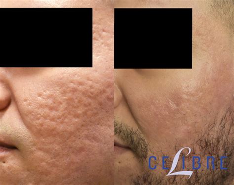 Acne Scar Removal Before and After Pictures of Actual Patients