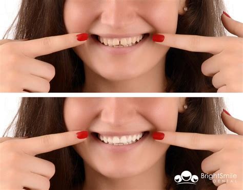 4 Ways To Fill The Perfect Smile