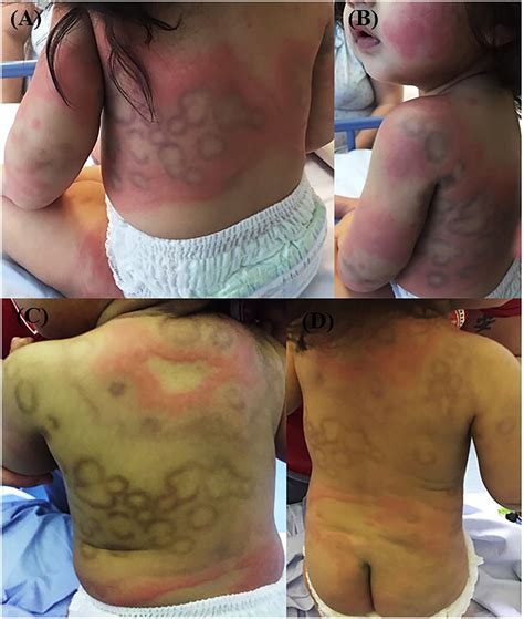 Urticarial Vasculitis In Toddlers