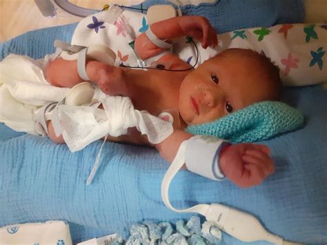 Baby with spina bifida undergoes surgery in his mum's womb to give him ...