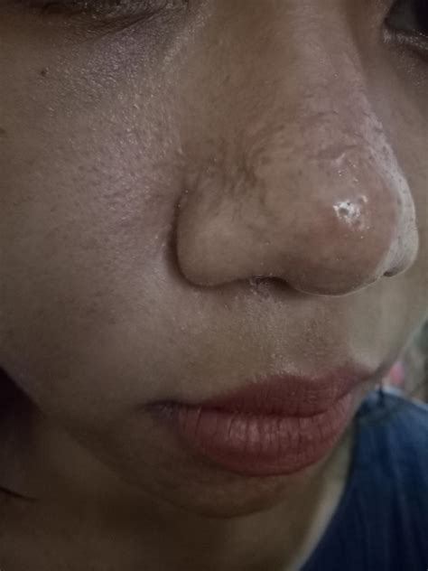 [skin concerns] My nose and chin area are covered with uneven oil/fat