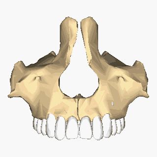 Реконструкция верхней челюсти | NEOPLASTY