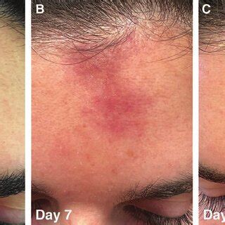 appearance   patients forehead   time points