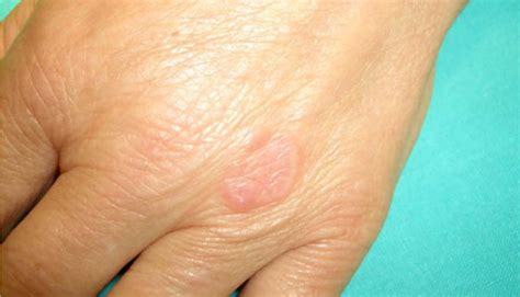 Yintoni iGranuloma?