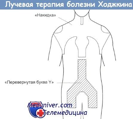 Лучевая терапия болезни Ходжкина и ее эффективность