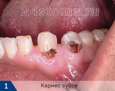 Кариес зубов – фото, причины развития, последствия для человека