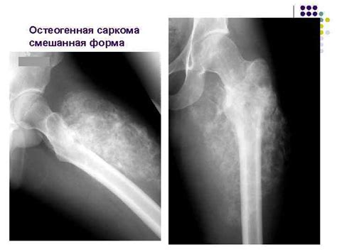 Рентгенодиагностика остеогенной саркомы Практикум для врачей интернов и