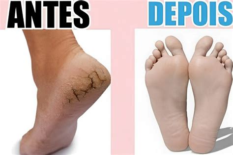 Pé Ressecado E Rachado - Pés rachados: dica para tratar pés ressecados que você já deveria ter ...