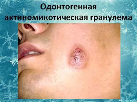 АКТИНОМИКОЗ Выполнила студентка 473 группы Онилэ Анастасия Александровна