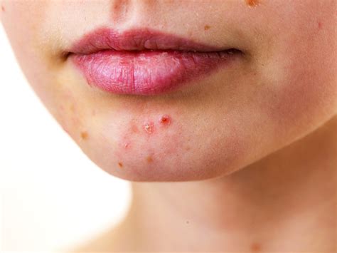What Is It? Perioral Dermatitis Vs Acne – Balmonds