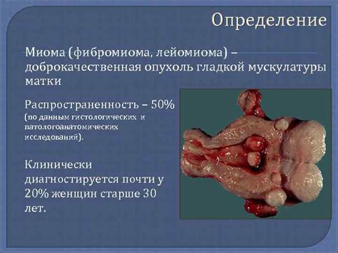 МИОМА МАТКИ