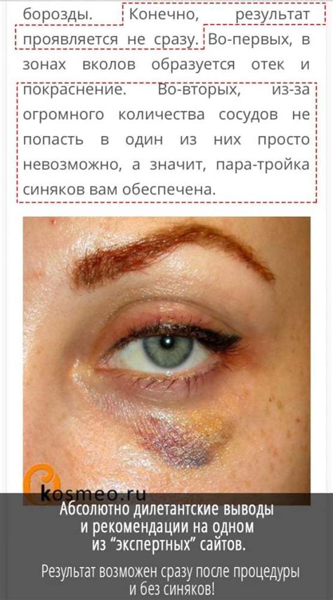 Как быстро свести синяк под глазом после удара