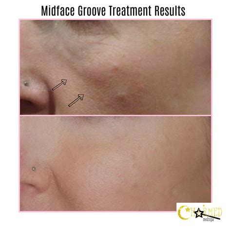 Midface Groove Treatment Results – Charmed Medispa