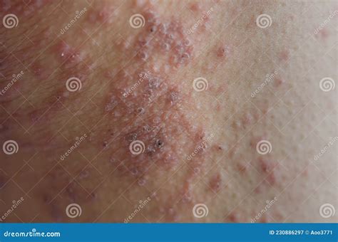 Close-up of Skin Rashes Caused by Allergies Stock Image - Image of ...