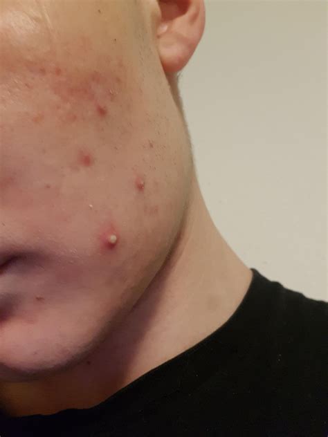 Exploding zits can cause permanent skin damage if ignored 16