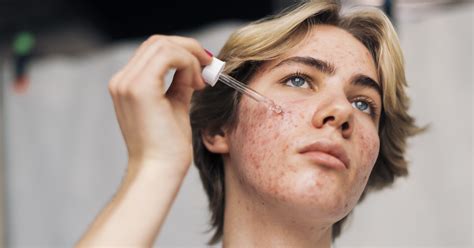 How to Treat Pimples Under the Skin, According to Derm | PS Beauty