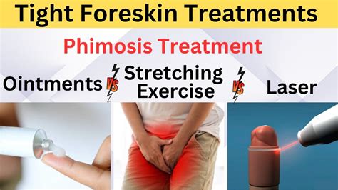 Tight Foreskin Treatments | Phimosis Treatment | Ointments v/s