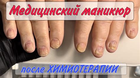 Химиотерапия / ногти после химиотерапии / медицинский маникюр - YouTube