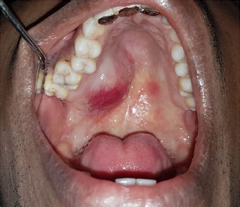 Hard Palate
