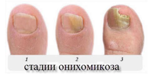 Онихомикоз ногтей - что это такое и препараты для лечения