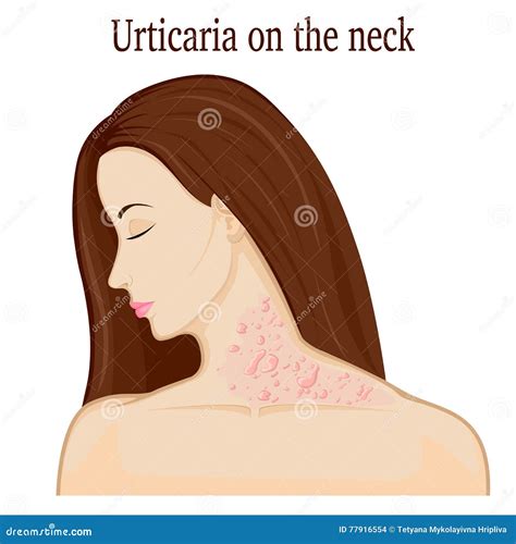 Hives Urticaria Vector Illustration. Labeled Skin Rash Explanation