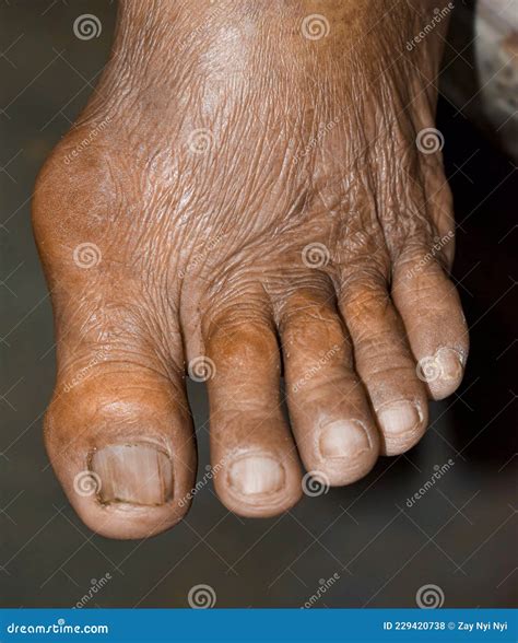 Rheumatoid Arthritis in Foot. Claw or Hammer Toes. Dislocation of