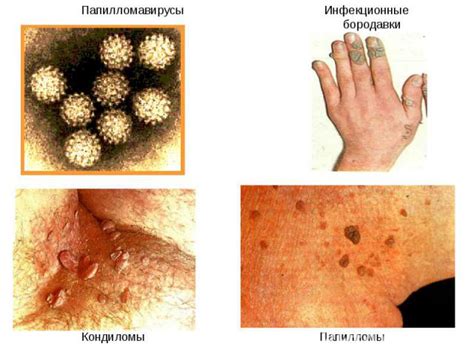 ВПЧ 16 типа у мужчин — эффективные методы лечения