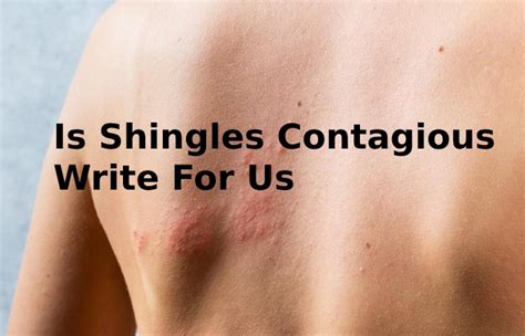 Is Shingles Contagious Write For Us - Guest Post, Contribute, and