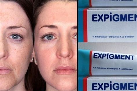 Expigment Krem Ne İşe Yarar? Nasıl Kullanılrı? - Moda Tasarım Kursu