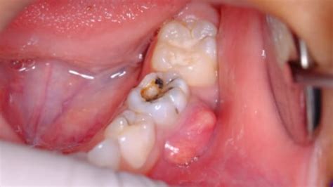long   tooth infection kills     teeth