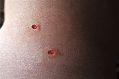 Two Fresh Punch Biopsy Wounds Testing For Melanoma Stock Photo - Download Image Now - iStock