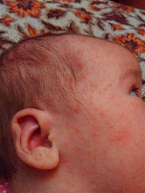сыпь — 9 ответов | форум Babyblog