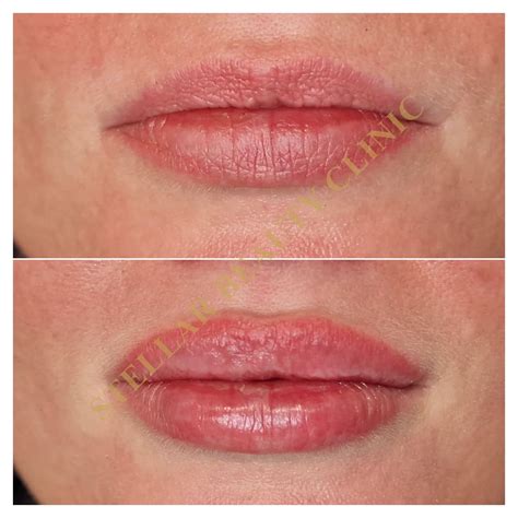 Контурная пластика - STELLAR BEAUTY CLINIC