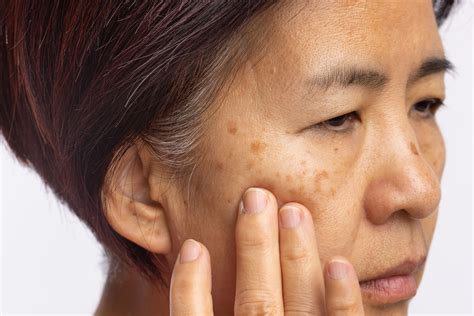 Manchas en la piel: melasma y léntigos solares, qué son y por qué aparecen