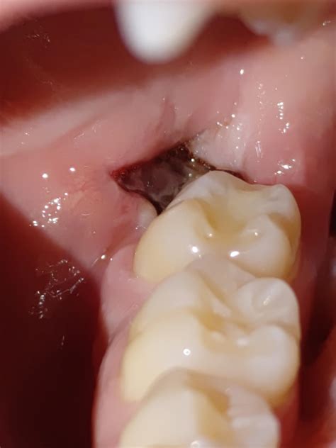 Does this look normal 4 days after a wisdom tooth extraction? : r