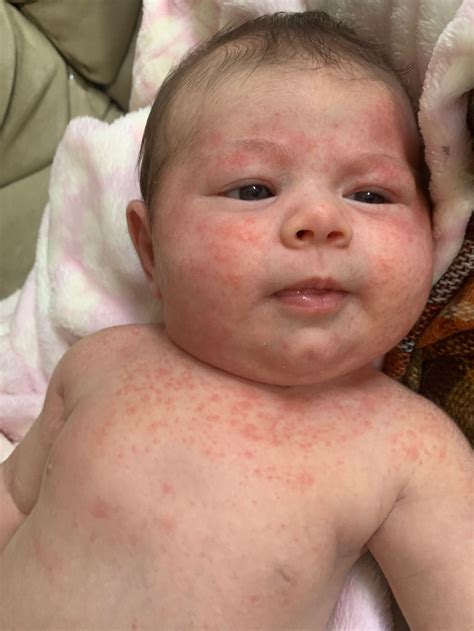 Top 20 Children’s Heat Rashes. Look аwfᴜɩ on your babies fасe and How ...