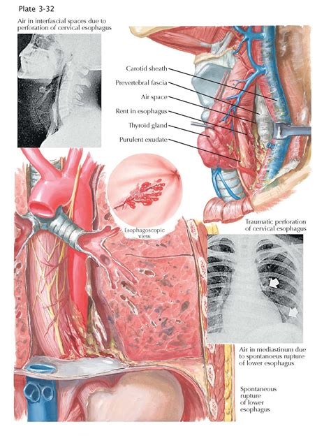 RUPTURE AND PERFORATION OF ESOPHAGUS - pediagenosis