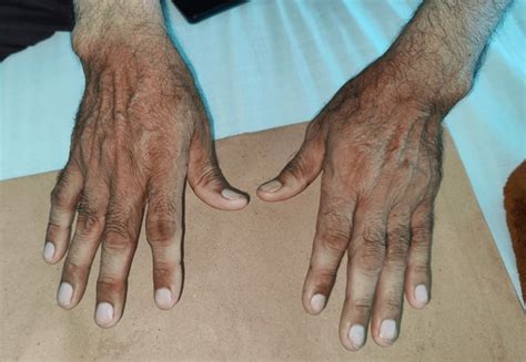 dorsal subluxation royalty  images stock  pictures