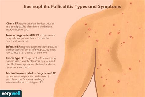 Eosinophilic Folliculitis: Symptoms, Treatment, and More