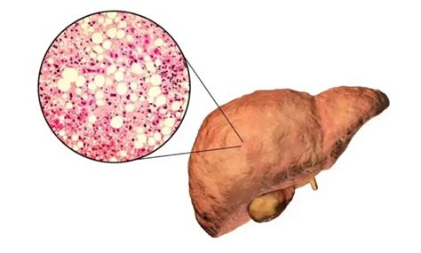 O Que É Hemangioma No Fígado - Hemangioma no Fígado é Grave: Diagnóstico e Implicações - Blog Dr ...