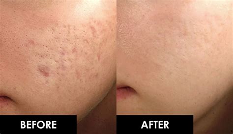 Microneedling Singapore - Best Acne Scar Removal Facial Treatment RF at ...