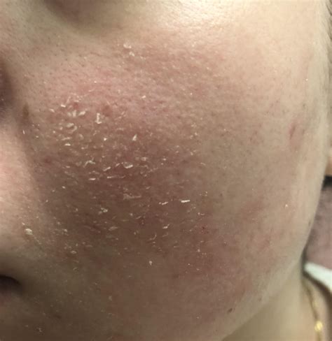 Face Rash From Cold Wind at Leona Freedman blog