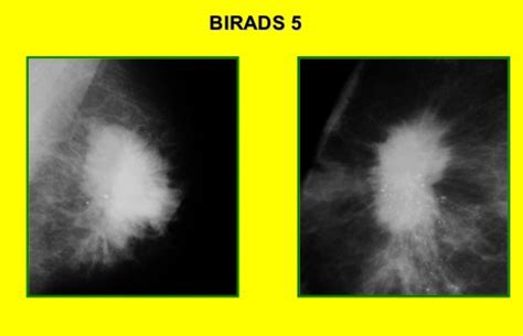 Birads классификация — 24Radiology.ru